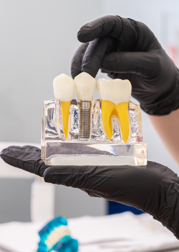 About Dental Implants