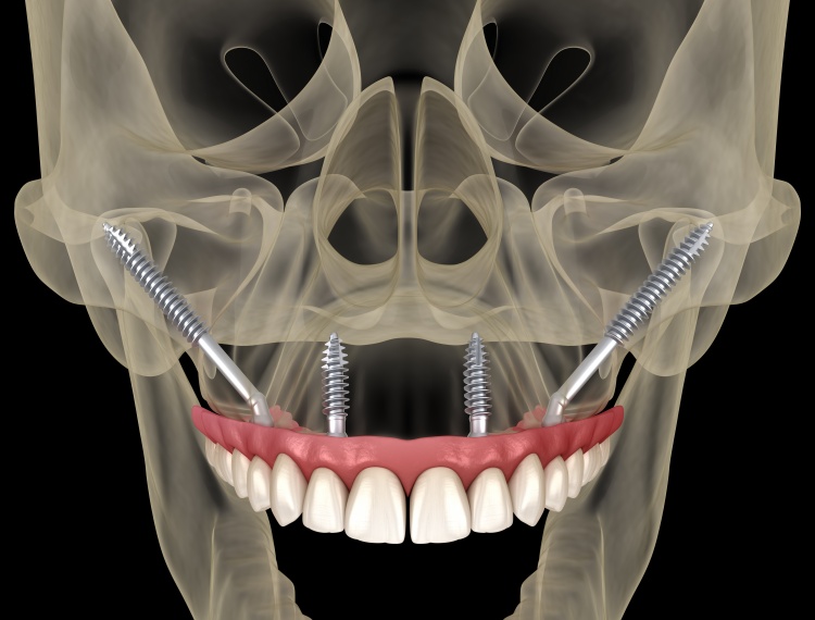 What are zygomatic implants