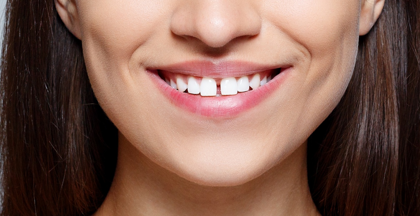 gaps between teeth