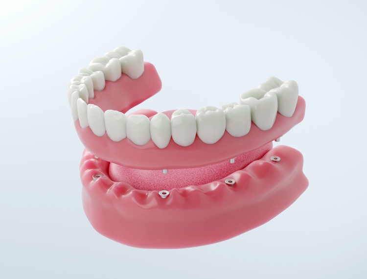 implant denture illustration