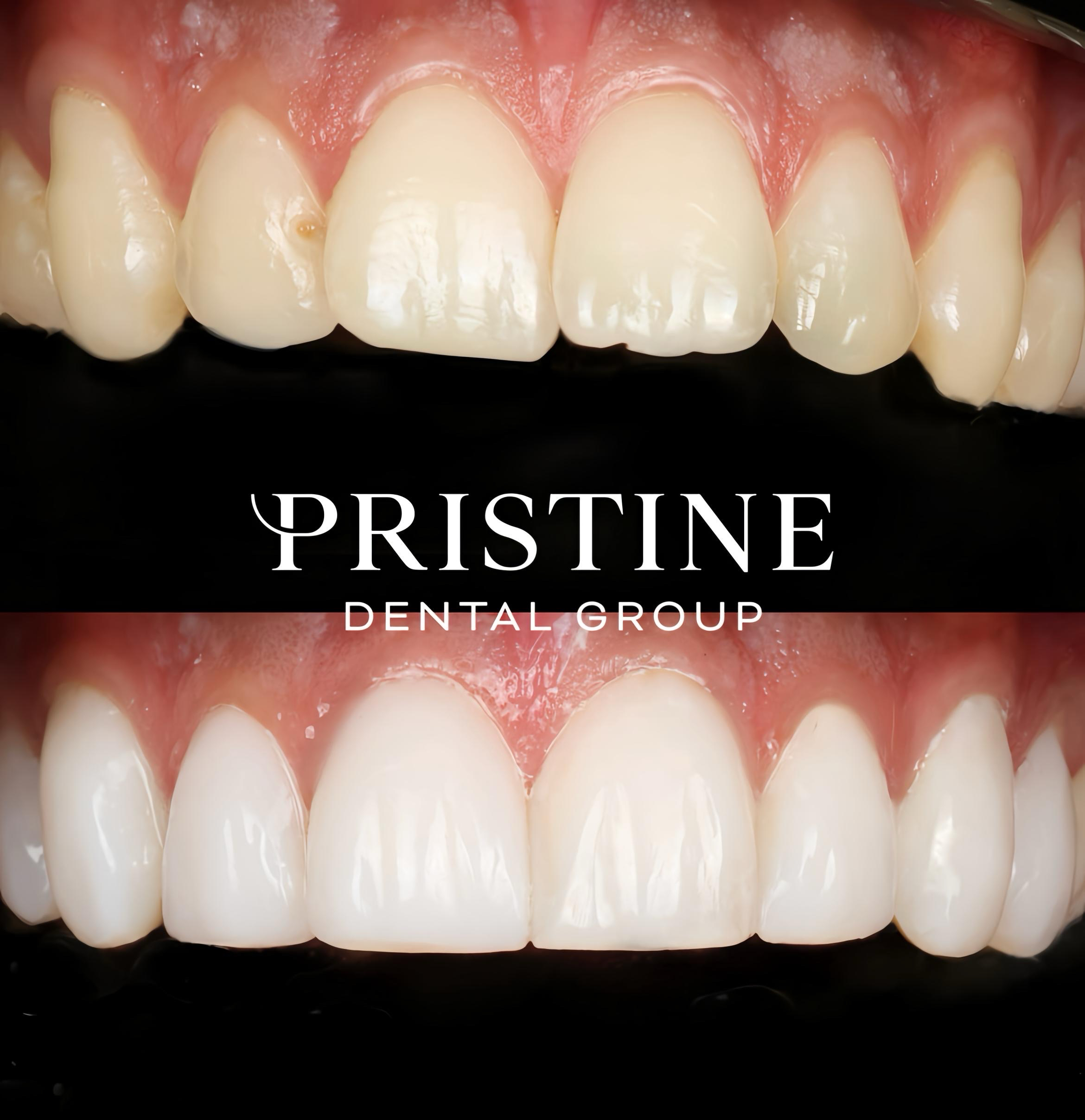 Composite bonding (3)
