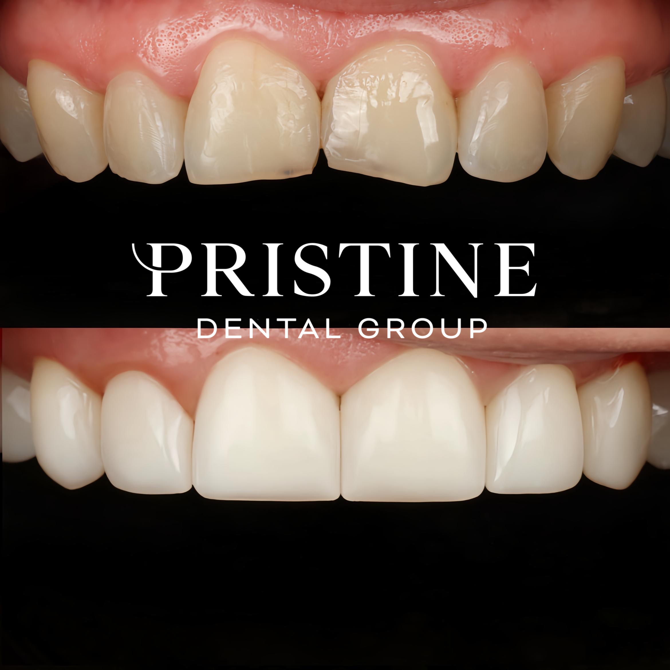 Composite bonding (6)
