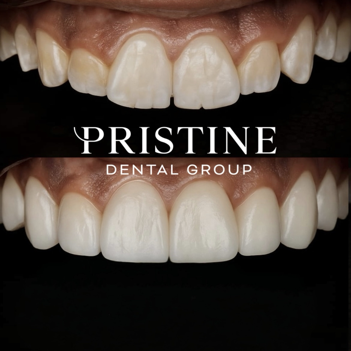 Composite bonding(1)