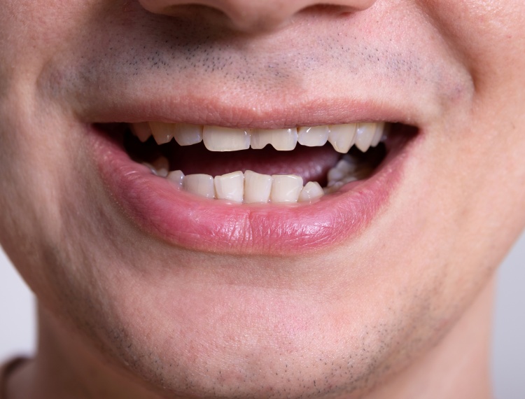 broken front tooth