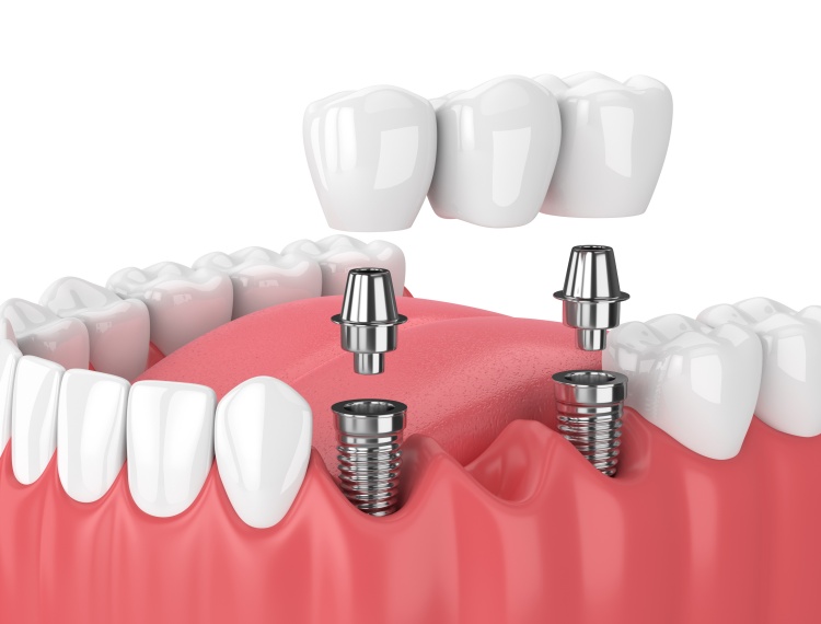 dental bridge